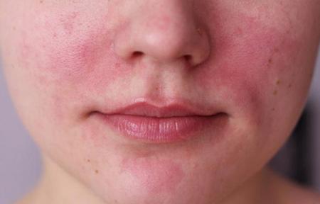 rosacea (1)
