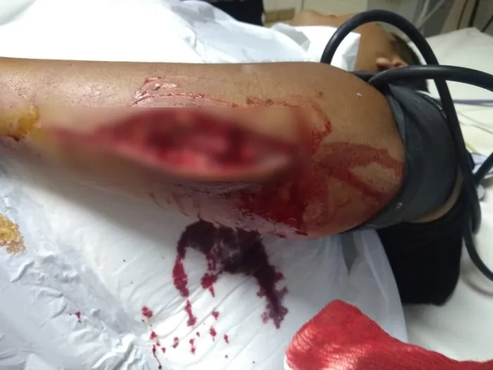 brazo cortado policia_phixr