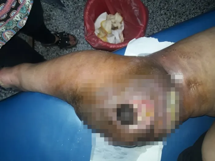 pierna-canceldepiel_phixr