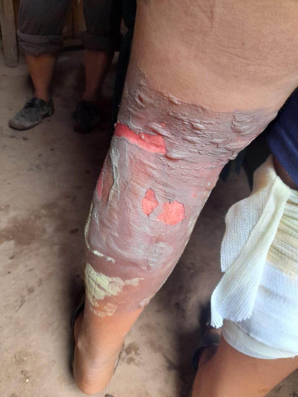 Niño El Sauzal quemaduras 1er grado