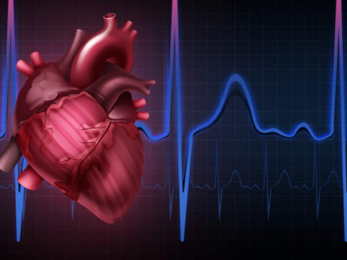 arritmia cardiaca