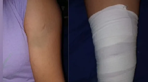 heridaaccidenteembarca