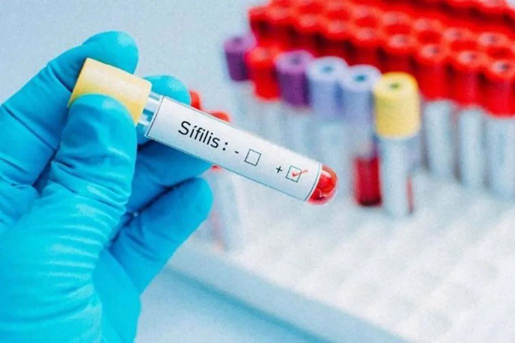 sifilis