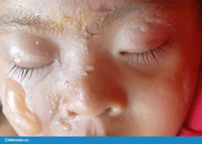 bebé quemado metán