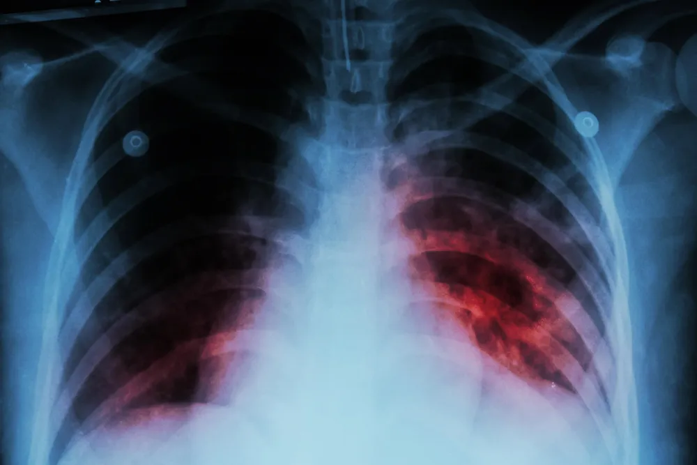 Tuberculosis_share