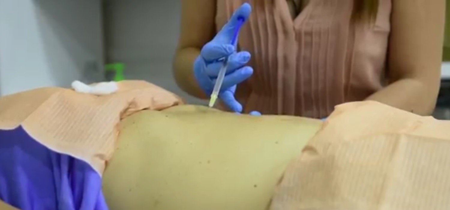 mesoterapia lipolitica