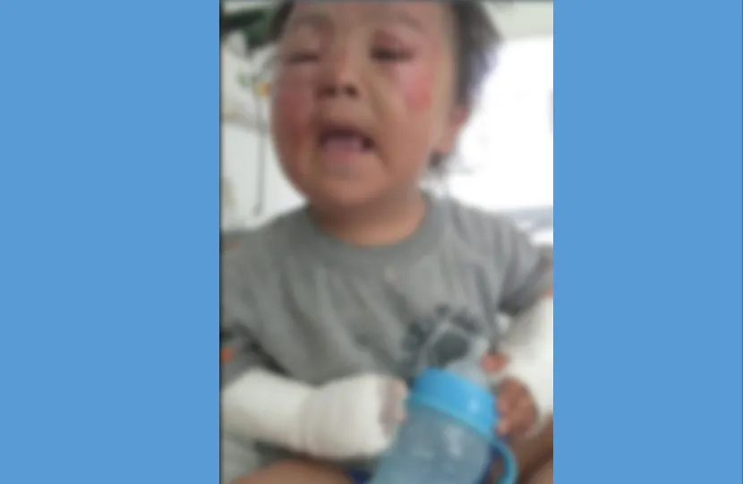 niño quemado